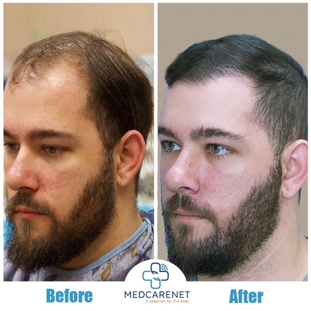 FUE Hair Transplant in Pakistan and stem cell is a popular option for hair  transplantation and a re  Best hair transplant Hair transplant surgery  Hair reduction